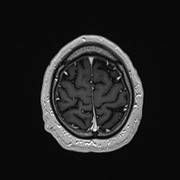 Cerebral arteriovenous malformation (Radiopaedia 84015-99245 Axial T1 C+ 135).jpg