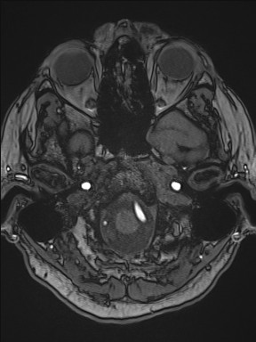 File:Cerebral arteriovenous malformation (Radiopaedia 84015-99245 Axial TOF 59).jpg