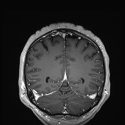 Cerebral arteriovenous malformation (Radiopaedia 84015-99245 Coronal T1 C+ 123).jpg