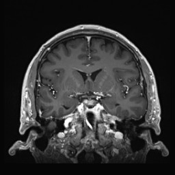 Cerebral arteriovenous malformation (Radiopaedia 84015-99245 Coronal T1 C+ 70).jpg