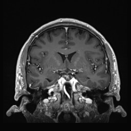 Cerebral arteriovenous malformation (Radiopaedia 84015-99245 Coronal T1 C+ 71).jpg