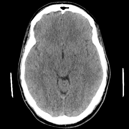 Cerebral arteriovenous malformation (Spetzler-Martin grade 2) (Radiopaedia 41262-44076 Axial non-contrast 25).png
