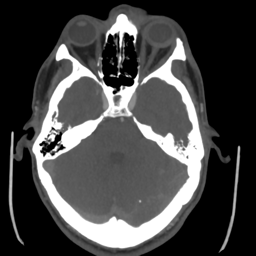 Cerebral arteriovenous malformation (Spetzler-Martin grade 2) (Radiopaedia 41262-44076 E 17).png
