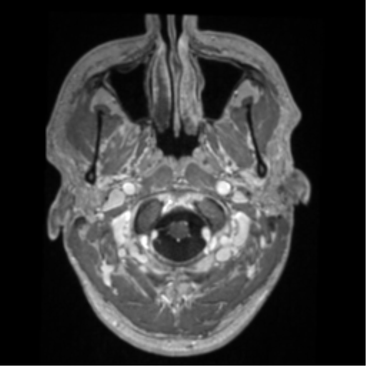 Cerebral arteriovenous malformation - huge (Radiopaedia 35734-37272 Axial T1 C+ 1).png