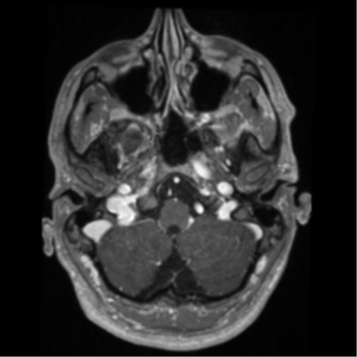 Cerebral arteriovenous malformation - huge (Radiopaedia 35734-37272 Axial T1 C+ 11).png