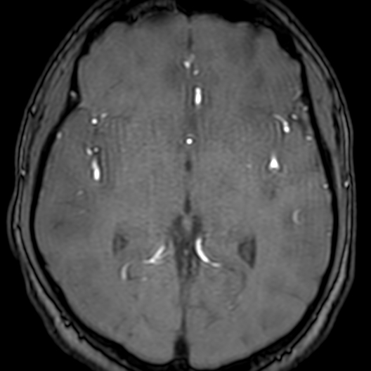 Cerebral arteriovenous malformation at posterior body of corpus callosum (Radiopaedia 74111-84925 Axial MRA 104).jpg