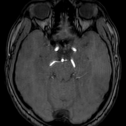 Cerebral arteriovenous malformation at posterior body of corpus callosum (Radiopaedia 74111-84925 Axial MRA 73).jpg