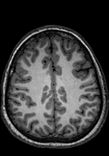 Cerebral arteriovenous malformation at posterior body of corpus callosum (Radiopaedia 74111-84925 Axial T1 78).jpg