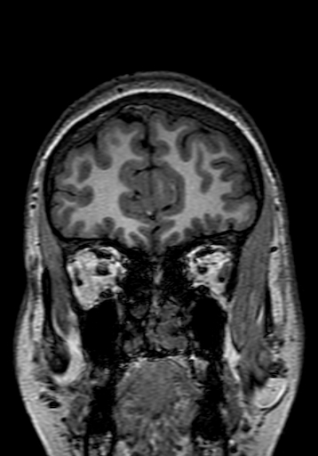 File:Cerebral arteriovenous malformation at posterior body of corpus callosum (Radiopaedia 74111-84925 Coronal T1 42).jpg
