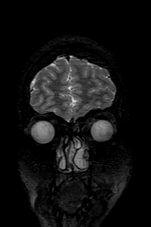 Cerebral arteriovenous malformation at posterior body of corpus callosum (Radiopaedia 74111-84925 Coronal T2 17).jpg