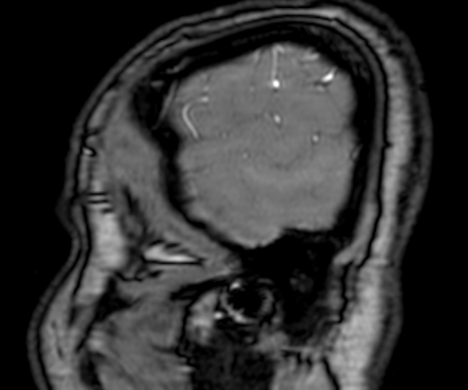 Cerebral arteriovenous malformation at posterior body of corpus callosum (Radiopaedia 74111-84925 J 5).jpg