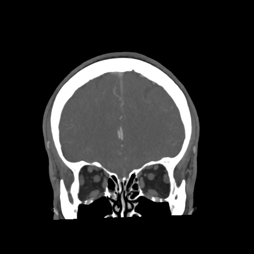 Cerebral arteriovenous malformation with lobar hemorrhage (Radiopaedia 35598-57216 C 23).jpg