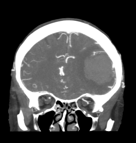 Cerebral arteriovenous malformation with lobar hemorrhage (Radiopaedia 44725-48511 B 16).png