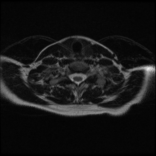File:Cerebral autosomal dominant arteriopathy with subcortical infarcts and leukoencephalopathy (CADASIL) (Radiopaedia 41018-43763 Ax T2 C2-T1 24).png