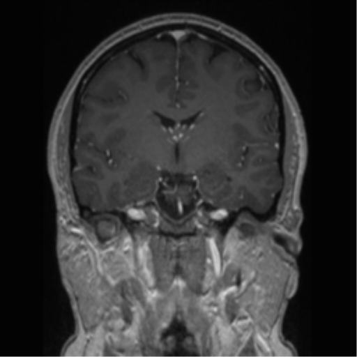 Cerebral cavernoma and development venous anomaly (Radiopaedia 37603-39482 Coronal T1 C+ 52).png