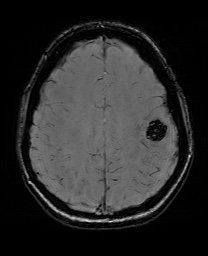 Cerebral cavernous venous malformation (Radiopaedia 70008-80021 I 54).jpg