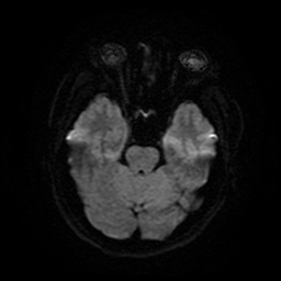 Cerebral cavernous venous malformation (Zabramski type II) (Radiopaedia 85511-101198 Axial DWI 12).jpg