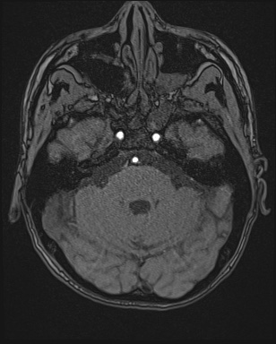 Cerebral embolic infarcts (embolic shower) (Radiopaedia 72391-82921 Axial MRA 32).jpg