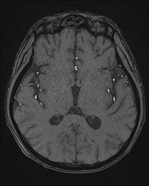 File:Cerebral embolic infarcts (embolic shower) (Radiopaedia 72391-82921 Axial MRA 95).jpg