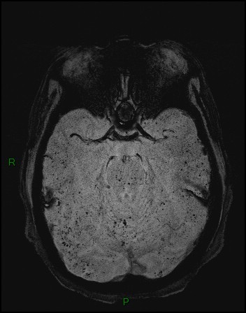 Cerebral fat embolism (Radiopaedia 35022-36525 Axial SWI 3).jpg