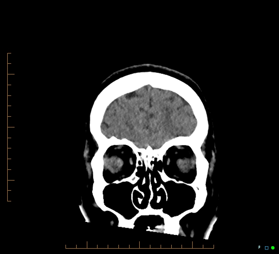 Cerebral fat embolism (Radiopaedia 85521-101220 Coronal non-contrast 13).jpg