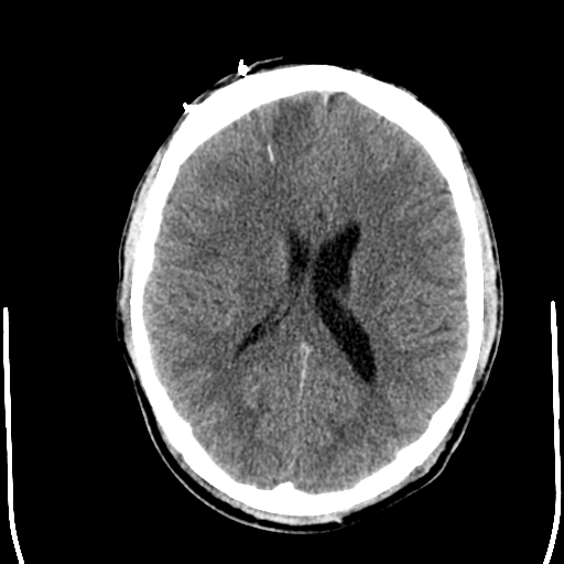 File:Cerebral hemorrhagic contusions- temporal evolution (Radiopaedia 40224-42754 Axial non-contrast 17).png