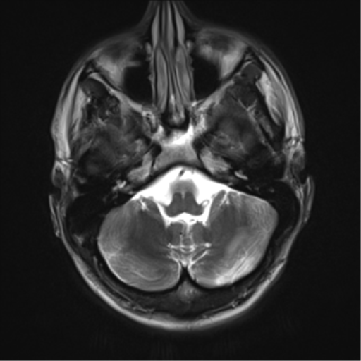 File:Cerebral hemorrhagic contusions- temporal evolution (Radiopaedia 40224-42757 Axial T2 4).png