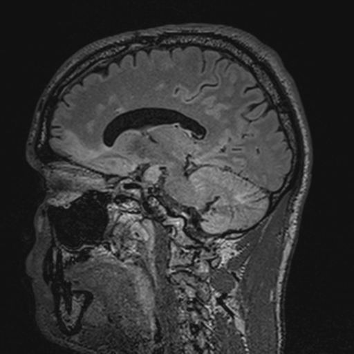 File:Cerebral hemorrhagic contusions- temporal evolution (Radiopaedia 40224-42757 Sagittal T1 34).png