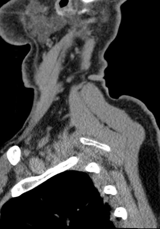 Cerebral hemorrhagic contusions and cervical spine fractures (Radiopaedia 32865-33841 G 14).jpg