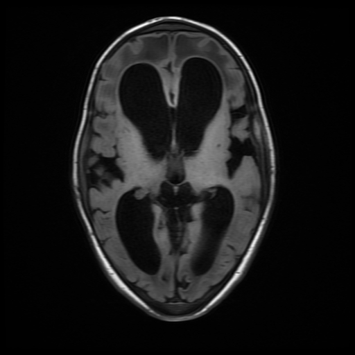 File:Cerebral manifestations of mucopolysaccharidosis type I (Radiopaedia 59171-66487 C 10).jpg
