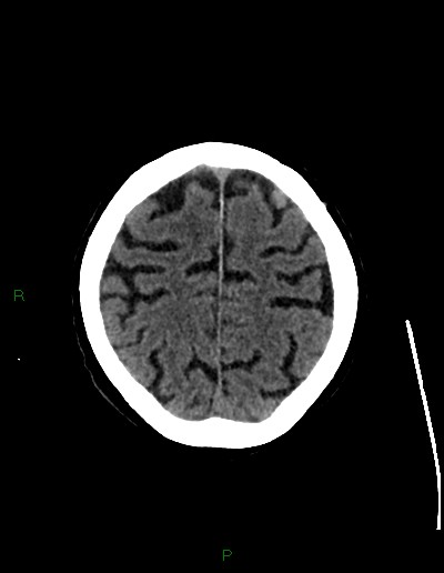 Cerebral metastases - ependymal and parenchymal (Radiopaedia 79877-93131 Axial non-contrast 64).jpg