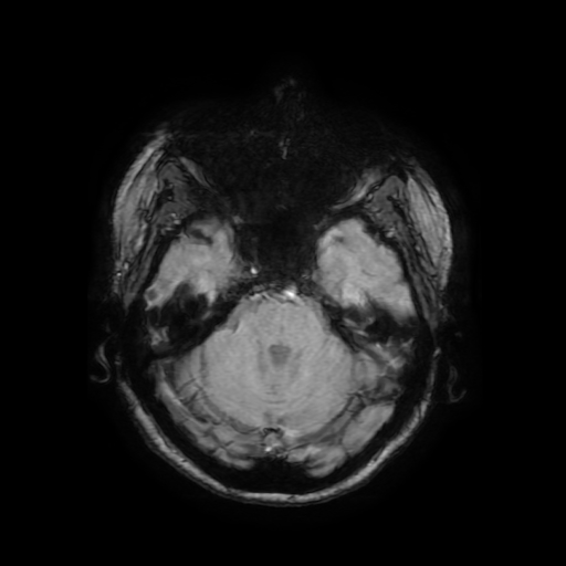Cerebral metastases - melanoma (Radiopaedia 80972-94522 Axial SWI 29).jpg