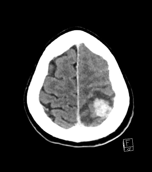 Cerebral metastases - testicular choriocarcinoma (Radiopaedia 84486-99855 Axial C+ delayed 12).jpg