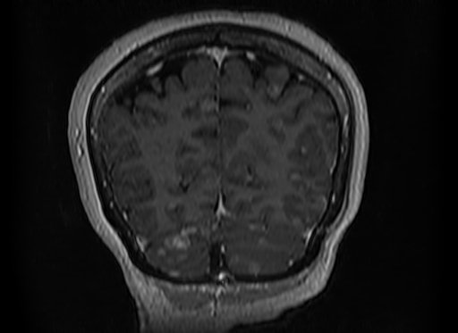 File:Cerebral metastases from lung cancer with amyloid angiopathy and cerebellopontine angle meningioma (Radiopaedia 74306-85191 Coronal T1 C+ 49).jpg