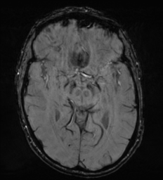 Cerebral metastasis - melanoma (Radiopaedia 54718-60954 Axial SWI 25).png