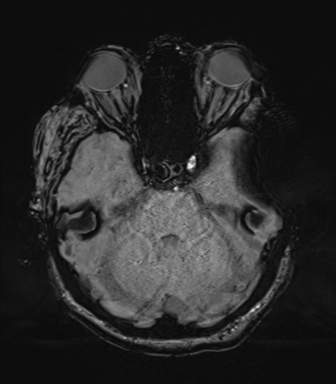 Cerebral metastasis to basal ganglia (Radiopaedia 81568-95413 Axial SWI 24).png