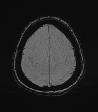 Cerebral metastasis to basal ganglia (Radiopaedia 81568-95413 Axial SWI 72).png