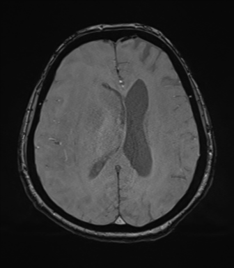File:Cerebral metastasis to basal ganglia (Radiopaedia 81568-95413 Axial SWI magnitude 54).png