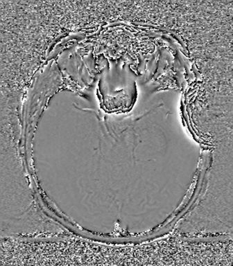 Cerebral metastasis to basal ganglia (Radiopaedia 81568-95413 Axial SWI phase 31).png