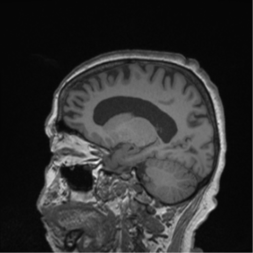 Cerebral metastasis to basal ganglia (Radiopaedia 81568-95413 Sagittal T1 26).png