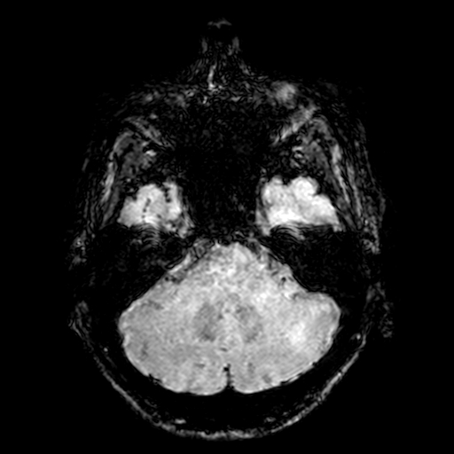 Cerebral parenchymal arteriovenous malformation (Radiopaedia 27280-27456 Axial SWI 18).jpg