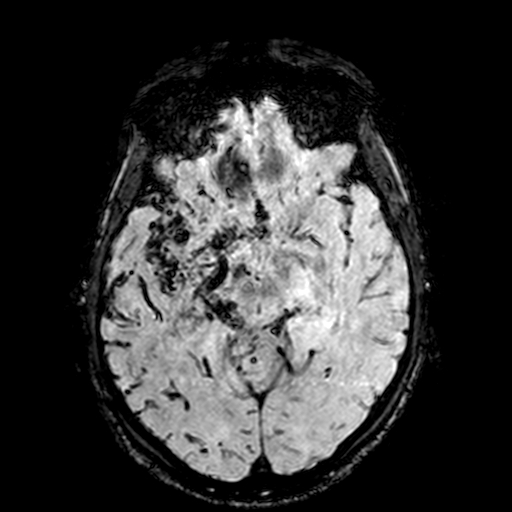 Cerebral parenchymal arteriovenous malformation (Radiopaedia 27280-27456 Axial SWI 46).jpg