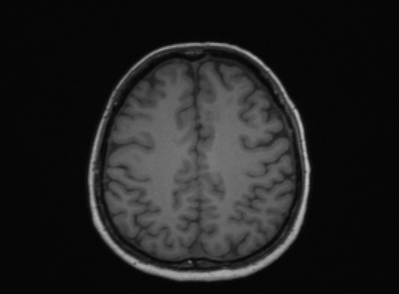 Cerebral ring enhancing lesions - cerebral metastases (Radiopaedia 44922-48817 Axial T1 170).jpg