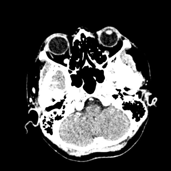 Cerebral ring enhancing lesions - cerebral metastases (Radiopaedia 44922-48818 B 57).jpg