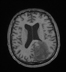 Cerebral toxoplasmosis (Radiopaedia 43956-47461 Axial T1 47).jpg