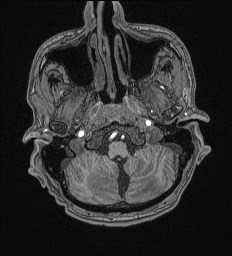 Cerebral toxoplasmosis (Radiopaedia 43956-47461 Axial T1 9).jpg