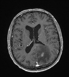 Cerebral toxoplasmosis (Radiopaedia 43956-47461 Axial T1 C+ 43).jpg