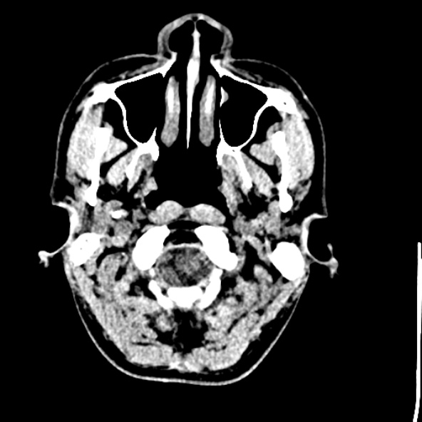 File:Cerebral toxoplasmosis (Radiopaedia 53993-60131 Axial non-contrast 7).jpg