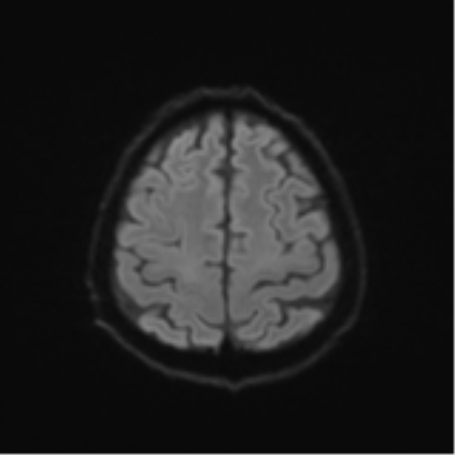 Cerebral toxoplasmosis (Radiopaedia 54575-60804 Axial DWI 58).png