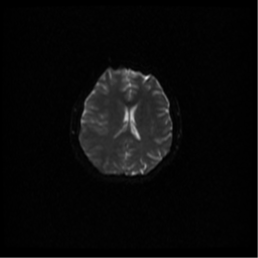 Cerebral venous hemorrhagic infarction (Radiopaedia 38461-40552 Axial DWI 61).png
